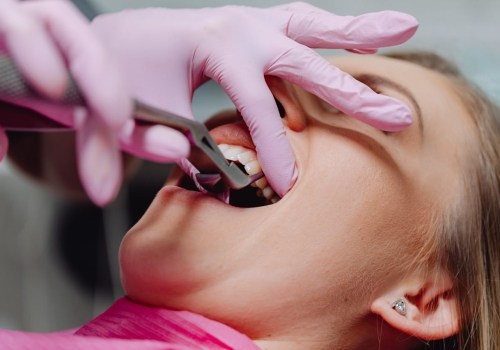 Tooth Extraction 101: What You Need To Know In Stockton, CA