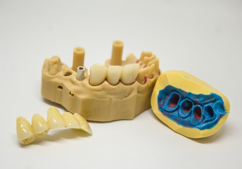 Preparing For Your Tooth Extraction: Tips From Dripping Springs General Dentists