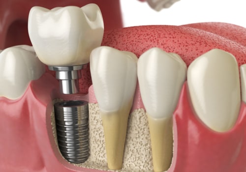 How To Prepare For Dental Implant Surgery After Tooth Extraction In Cedar Park, TX