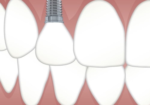Restore Your Smile with Implants After Tooth Extraction