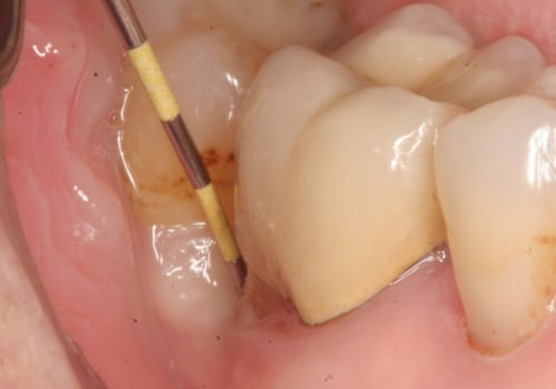 Will an Abscess Go Away After Tooth Extraction?