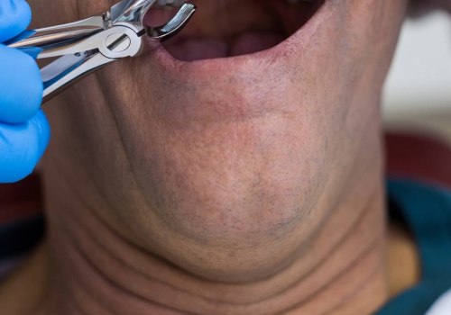 Everything You Need to Know About Tooth Extraction